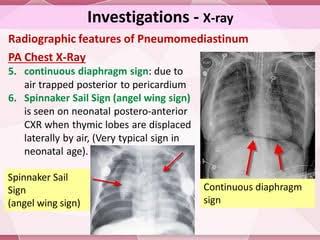 medicalinfo0's tweet photo. @NephroP Pneumomediastinum https://t.co/6xkr8N1TlP