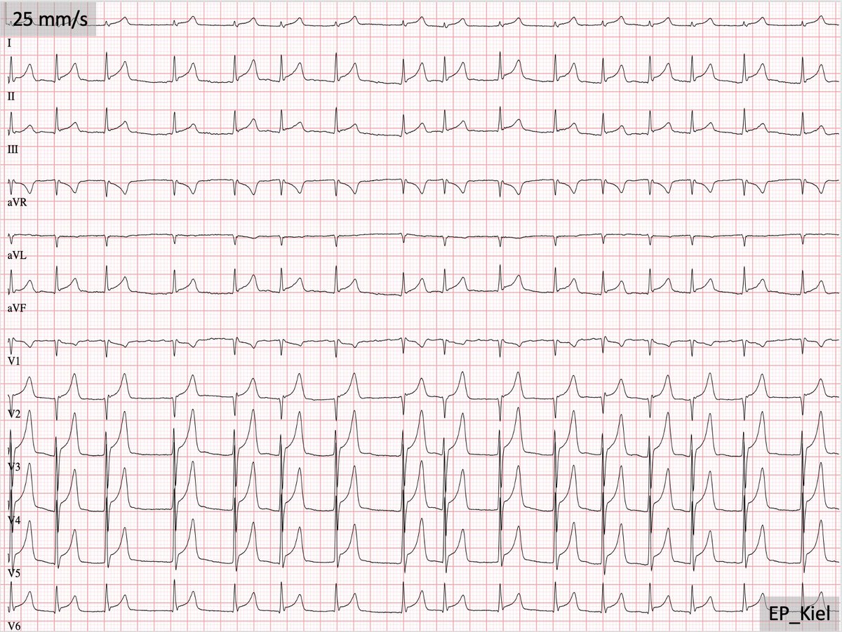 Case 10. Male, 81yo, admission due to worsening Dyspnoea, NYHA III-IV. 1 Month ago LAA Occluder implantation. What is the most probable diagnosis?
#EPeeps #Cardiotwitter #FOAMed #EP_Kiel #ecgeducation <a href="/evgeny_lyan/">Evgeny Lian</a> <a href="/ThomasDemming/">Thomas Demming</a>