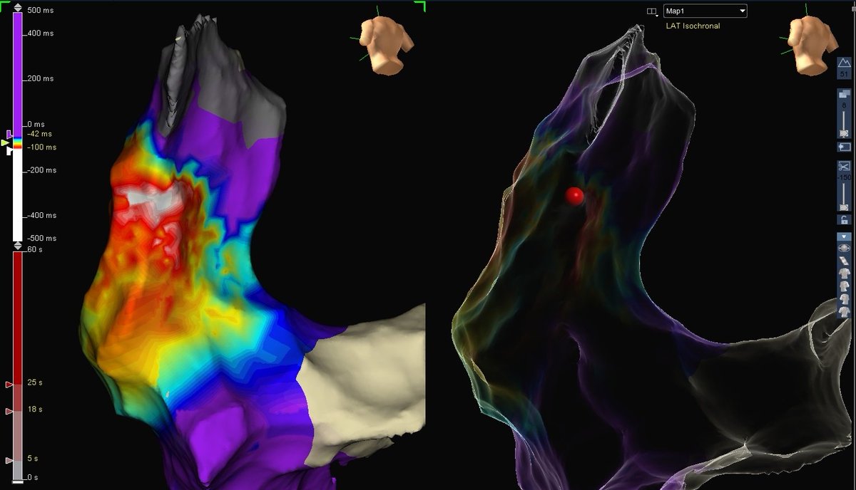 DenislavBoychev's tweet photo. Looks like an epidemy of RVOT cases in the last week.. 35 yo female in incesant VT with inferior axis, LBBB morphology and transition in V3. Only 1 RF aplication at the sweet spot with instant termination of the tachy and no further inducibility of the VT. https://t.co/WyNrhZve4v