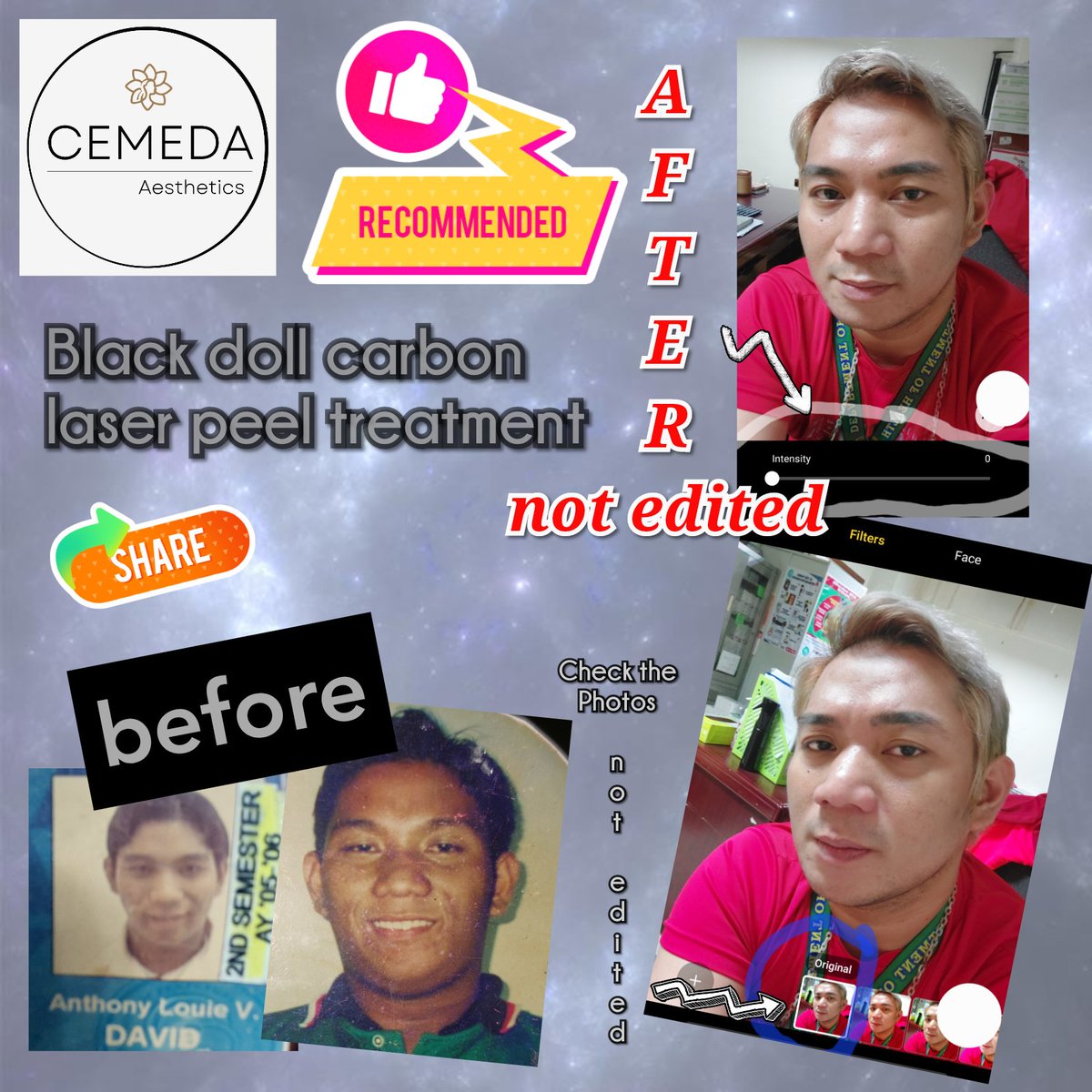 antondavid143's tweet photo. Black Doll Carbon Laser Peel P999.00 per session
or P2500 (3 sessions) with Organic Seaweed Mask for added benefits.
#kuyaLOUIE #PLHIVDiaries #HIV #Cemeda https://t.co/oNHioNLgwf