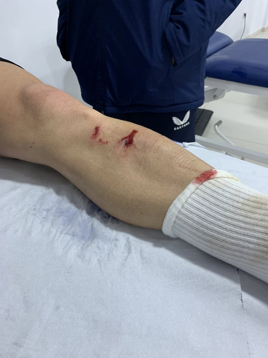 AntonioMtnzP's tweet photo. Desde el minuto 4 jugando con una herida de taco abierta en la tibia, un antiinflamatorio al descanso y aún así, Fernando Martínez fue el hombre del partido para el Almería. 

@marca https://t.co/o39WnAw3bo