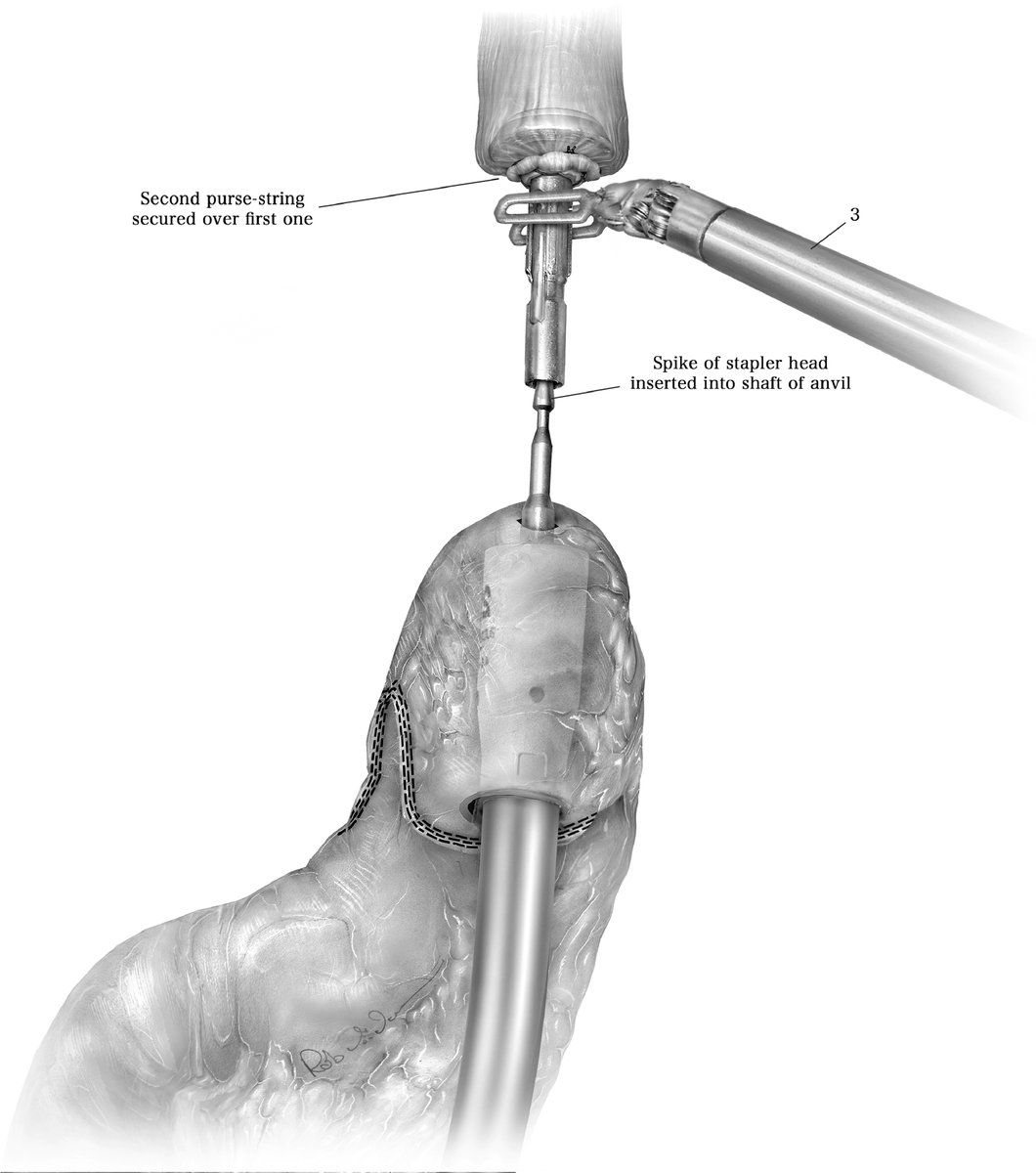 AATS Journals (@aatsjournals) on Twitter photo #IvorLewis Robot-Assisted Minimally Invasive Esophagectomy (#RAMIE): The <a href="/UPMC_CTSurgery/">Pitt Cardiothoracic Surgery Department</a> Technique. By Kuiper, Luketich & Sarkaria in OpTechs. F10-13 attached. Article available here: doi.org/10.1053/j.opte… #JTCVS <a href="/tssmn/">CTSurgSocMedNetwork</a> #esophagectomy #esophagealcancer #SoMe4Surgery #CTSurgery #IvorLewis Robot-Assisted Minimally Invasive Esophagectomy (#RAMIE): The <a href="/UPMC_CTSurgery/">Pitt Cardiothoracic Surgery Department</a> Technique. By Kuiper, Luketich & Sarkaria in OpTechs. F10-13 attached. Article available here: doi.org/10.1053/j.opte… #JTCVS <a href="/tssmn/">CTSurgSocMedNetwork</a> #esophagectomy #esophagealcancer #SoMe4Surgery #CTSurgery