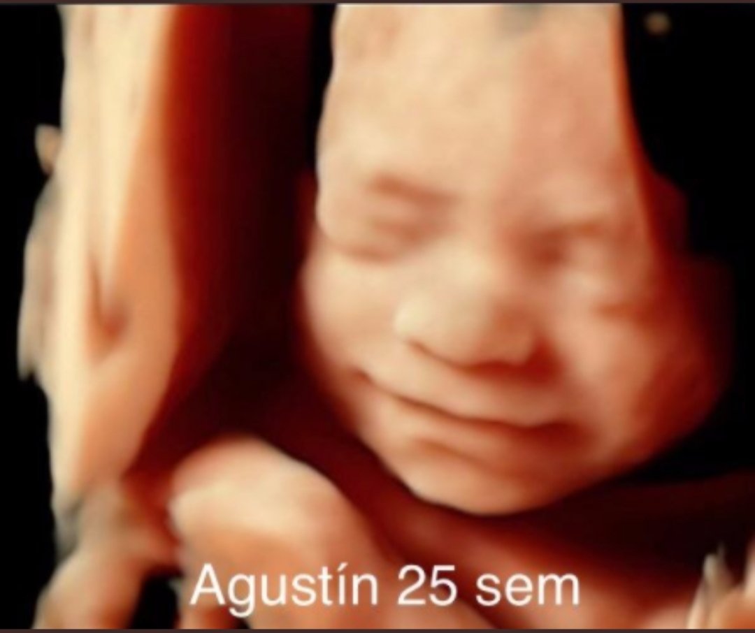 raquel07031960's tweet photo. Dicen que el aborto no mata porque el prenatal no siente dolor ni puede vivir fuera del útero, pero resulta que desde el sexto mes ya puede vivir fuera del vientre, sentir dolor e igualmente se realizan abortos.
Como Agustín👇 era el bebé que mataron en Santa Fe la semana pasada. https://t.co/KKddHoABIJ