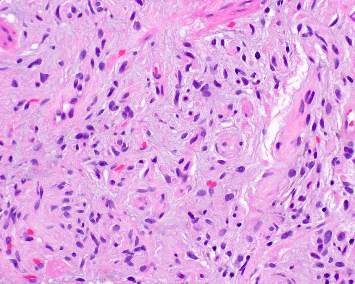 This colonic neurofibroma arose in a patient with neurofibromatosis, Type 1 (NF1).