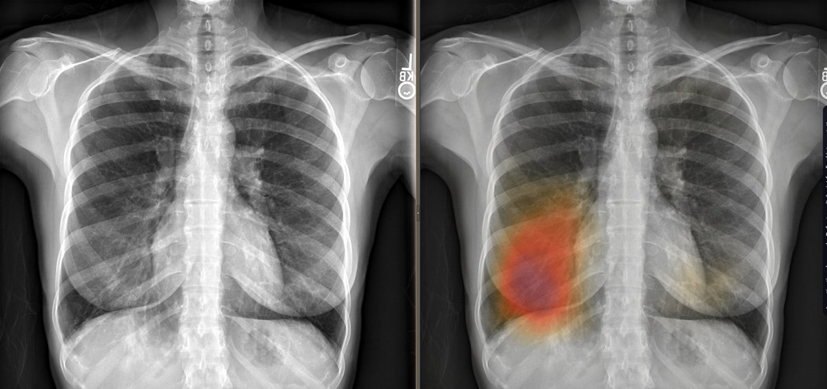 HsiaoMDPhD's tweet image. For #ImagingAI algorithms to work in clinical practice, they need to be designed to function in many contexts. I&apos;m still amazed by #radres @BJHurtMD&apos;s algorithm via @ArterysInc, still working hard 😎, detecting pneumonia beyond #covid (CT-confirmed).  journals.lww.com/thoracicimagin…
