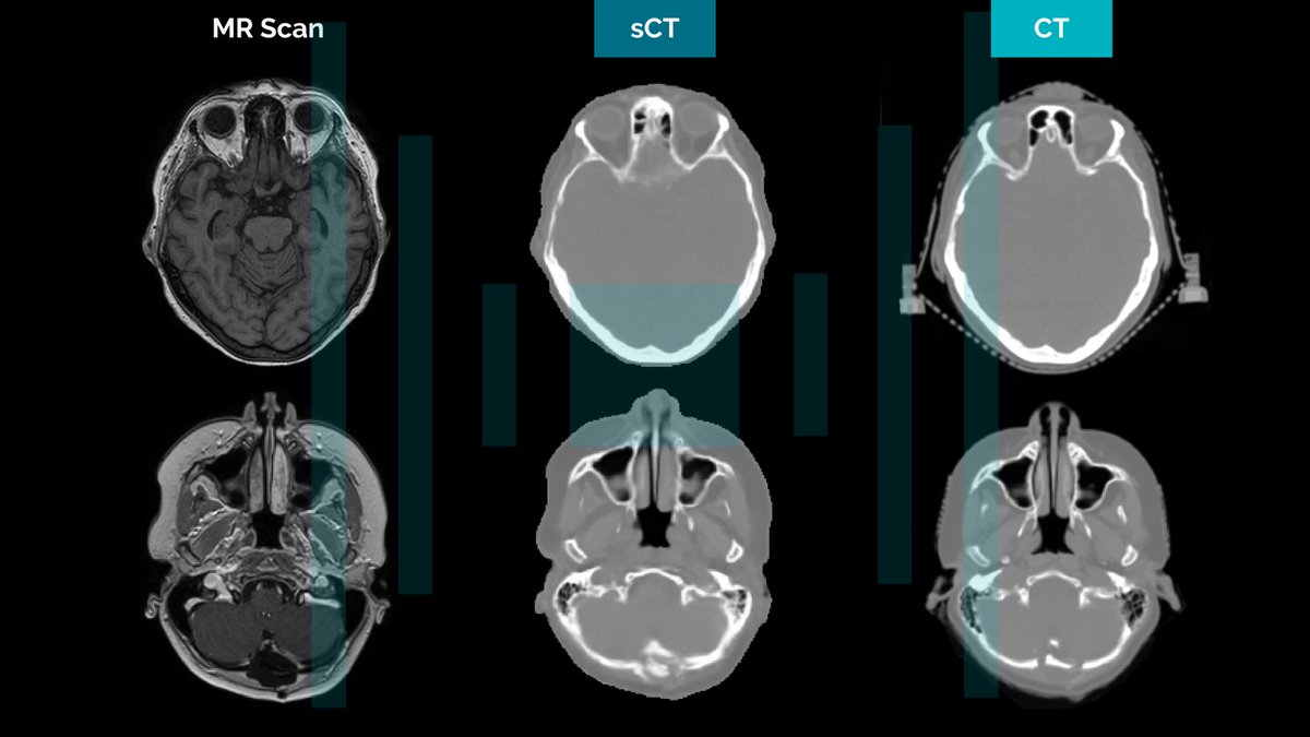 mvisionai's tweet photo. #MVision 2023 challenge: developing a robust and high-quality deep learning (#DL)-based Synthetic image creation product for #RadioTherapy🦾 Here is the article that describes generation of synthetic CT Images From MRI for #RadiationTherapy planning 🧑‍💻 ⟹ https://t.co/aN2kGwnCED https://t.co/0GaCmFkwQp