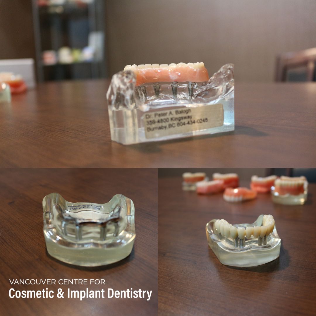 There are many advantages to dental implants. 

They can:
🦷 Secure a crown for one tooth,
🦷 Secure a bridge 
🦷 Replace a partial denture
🦷 Secure a upper or lower denture
🦷 Replace teeth

Contact us to book your appointment!
Phone: (604) 243-0048
Email: info@vccid.com