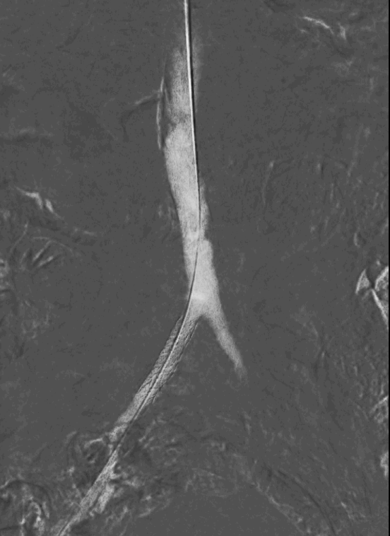 DrAlonsoGlez's tweet photo. 👴79 años Isquemia crónica MID categoría 5 Rutherford (lesión en 4º dedo que no cura y dolor nocturno).
Paciente en insuficiencia renal. Cr= 2.3 mg/dl ➡ Arteriografía con CO2 (Angiodroid) post preparación intestinal 48h
Estenosis crítica en AICD. stent cubierto 37x8mm. https://t.co/aRNTrxk7u6