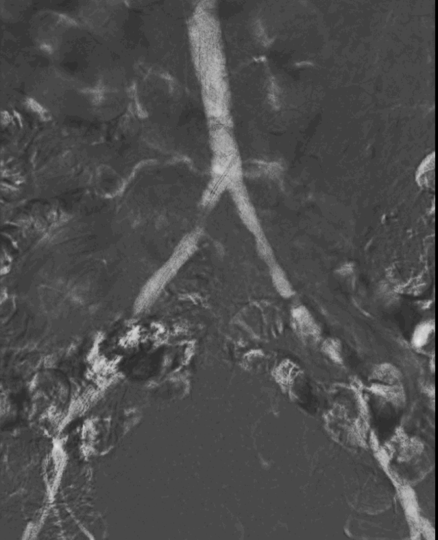 DrAlonsoGlez's tweet photo. 👴79 años Isquemia crónica MID categoría 5 Rutherford (lesión en 4º dedo que no cura y dolor nocturno).
Paciente en insuficiencia renal. Cr= 2.3 mg/dl ➡ Arteriografía con CO2 (Angiodroid) post preparación intestinal 48h
Estenosis crítica en AICD. stent cubierto 37x8mm. https://t.co/aRNTrxk7u6