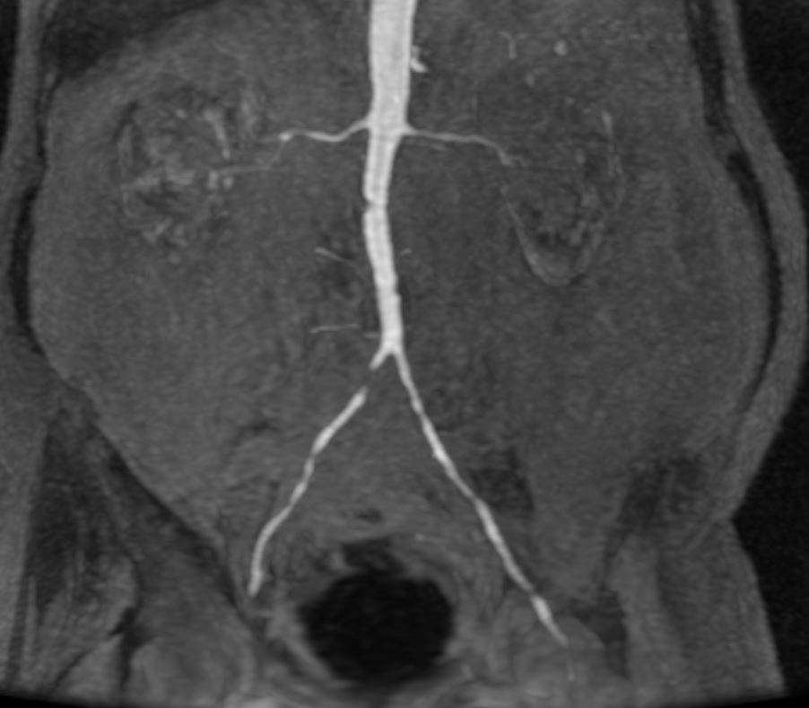 DrAlonsoGlez's tweet photo. 👴79 años Isquemia crónica MID categoría 5 Rutherford (lesión en 4º dedo que no cura y dolor nocturno).
Paciente en insuficiencia renal. Cr= 2.3 mg/dl ➡ Arteriografía con CO2 (Angiodroid) post preparación intestinal 48h
Estenosis crítica en AICD. stent cubierto 37x8mm. https://t.co/aRNTrxk7u6