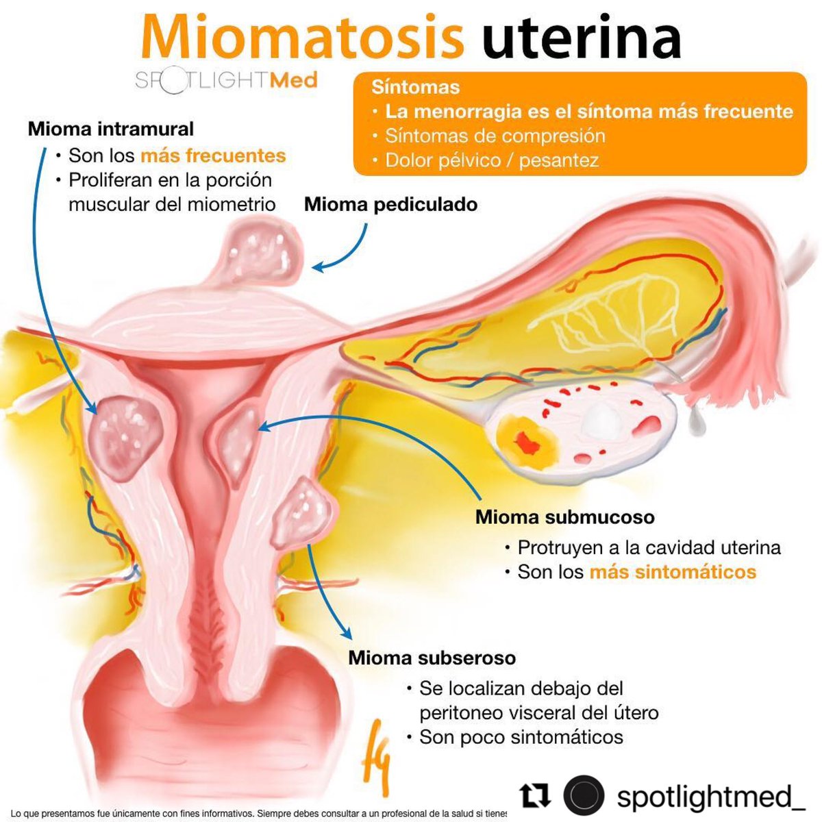 Miomatosis uterina 🙍🏻‍♀️
#SpotlightMed #Spotlight #Spotlightmedicine #medschool #medlife #medstudent #medstudentlife #ginecologia #gynecology #mip #mpss #enarm #enarm2023