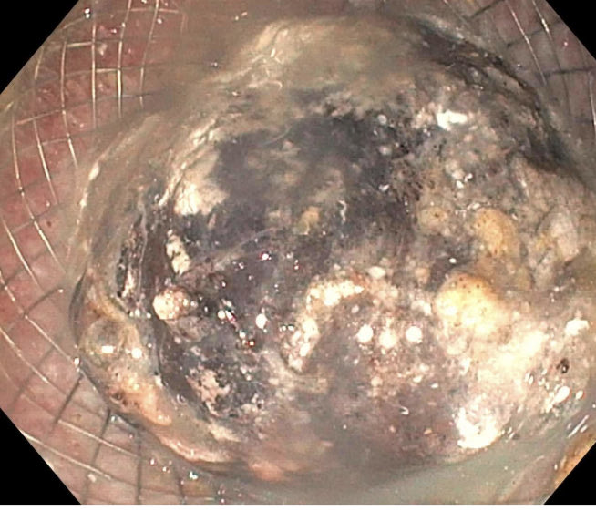 EUSandEndoscopy's tweet photo. Occluded #AXIOS #LAMS #cystgastrostomy easily opened & nice & easy #necrosectomy with #ENDOROTOR performed. Plastic pigtail placed to maintain patency pending fu directed endoscopic necrosectomy in a week. @DouglasAdlerMD & I doing several these a week https://t.co/DgZd5sVCfz