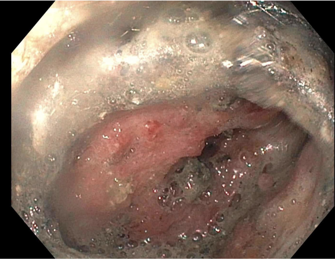 EUSandEndoscopy's tweet photo. Occluded #AXIOS #LAMS #cystgastrostomy easily opened & nice & easy #necrosectomy with #ENDOROTOR performed. Plastic pigtail placed to maintain patency pending fu directed endoscopic necrosectomy in a week. @DouglasAdlerMD & I doing several these a week https://t.co/DgZd5sVCfz