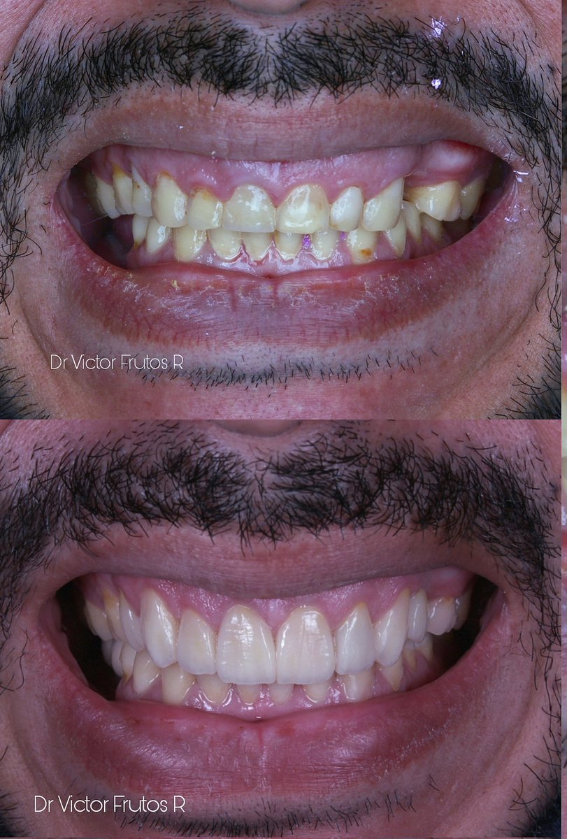 Que valor le das a tu sonrisa?? Un poco de lo que hago y lo que tanto me apasiona! #odontología #salud