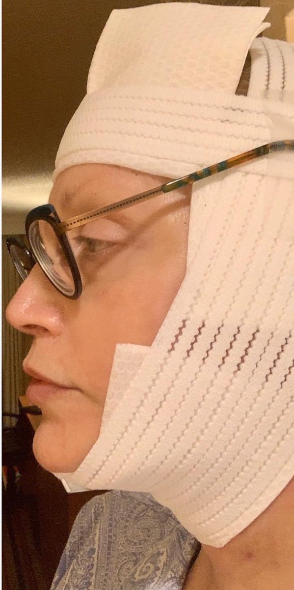 mardipantz's tweet photo. My surgeon knew the assignment! 
3 years ago today 3 days after Facelift at 58. 
I always had a lazy neck which gave me much gender &amp; later age dysphoria.
Out of all my surgeries, I think it is the one I appreciate the most🙏🏼🔪🤡
#lifelivedtrans #TransRightsAreHumanRights #LGBTQ https://t.co/b24mAXaEoo