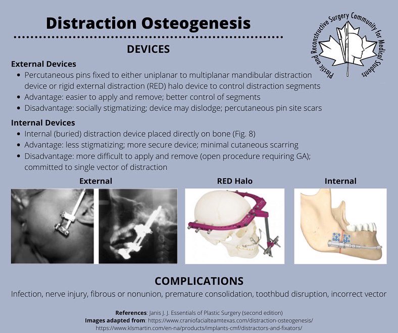 prscommunity's tweet photo. ❗️Educational post alert❗️

Our first educational post of the year and we are starting off strong with a fantastic post by Arashk Ghasroddashti on distraction osteogenesis 🤩 https://t.co/PNOUs07rFz