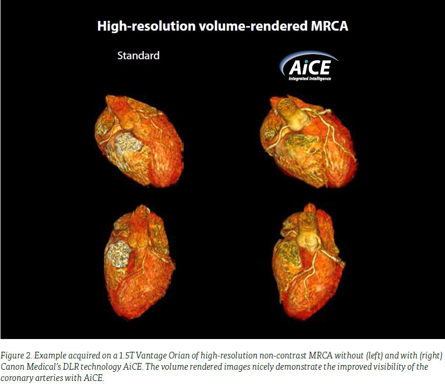 CanonMedical's tweet photo. To discover insights on how #AI enables high-resolution non-contrast #MRI Coronary Angiography visit https://t.co/1qgCDAcmP5 . #PoweredByAltivity https://t.co/L621wYjnr4