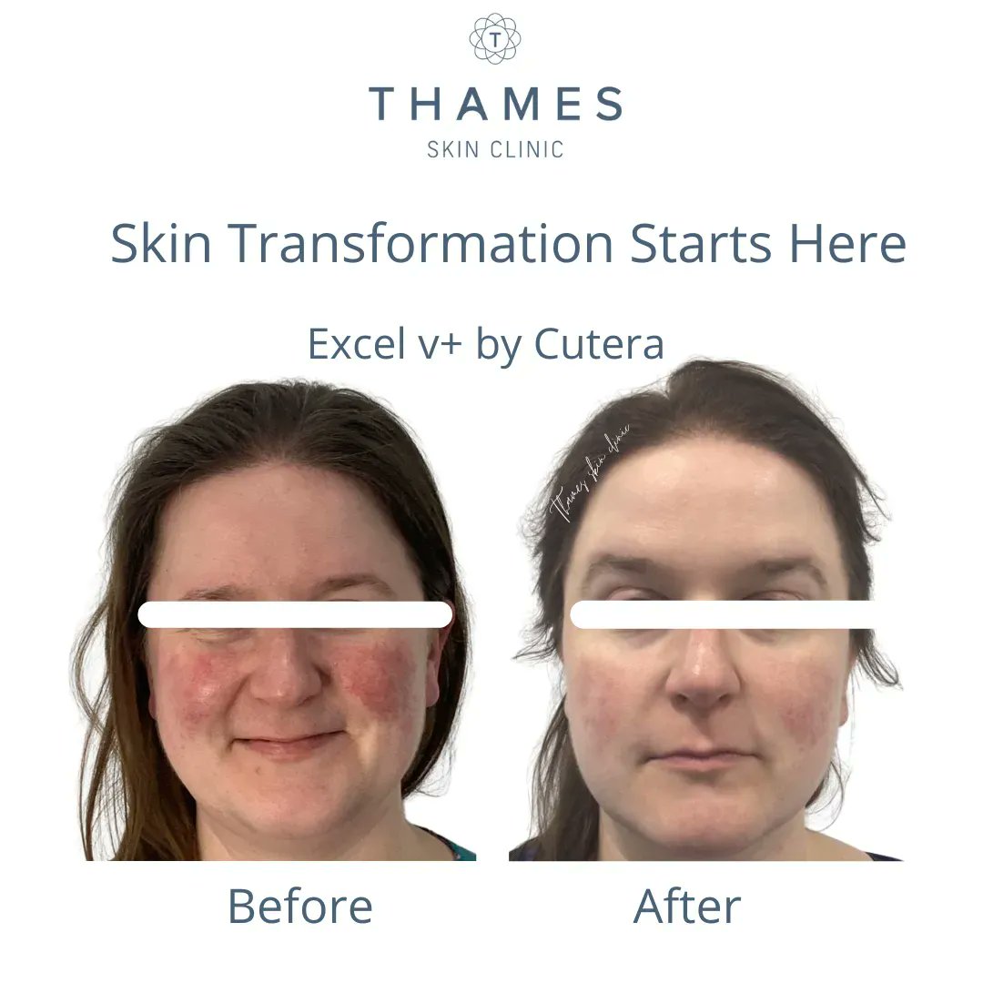 SkinThames's tweet image. 💥 💥 💥 💥 💥 💥
Incredible results with our @Cutera Excel v+ device to reduce this patients redness/ rosacea.
Only 3 sessions!
Results vary per patient.
#cutera #whycutera #excelv+ #laser #rosacea #redness #skinrejuventation #beforeandafter
