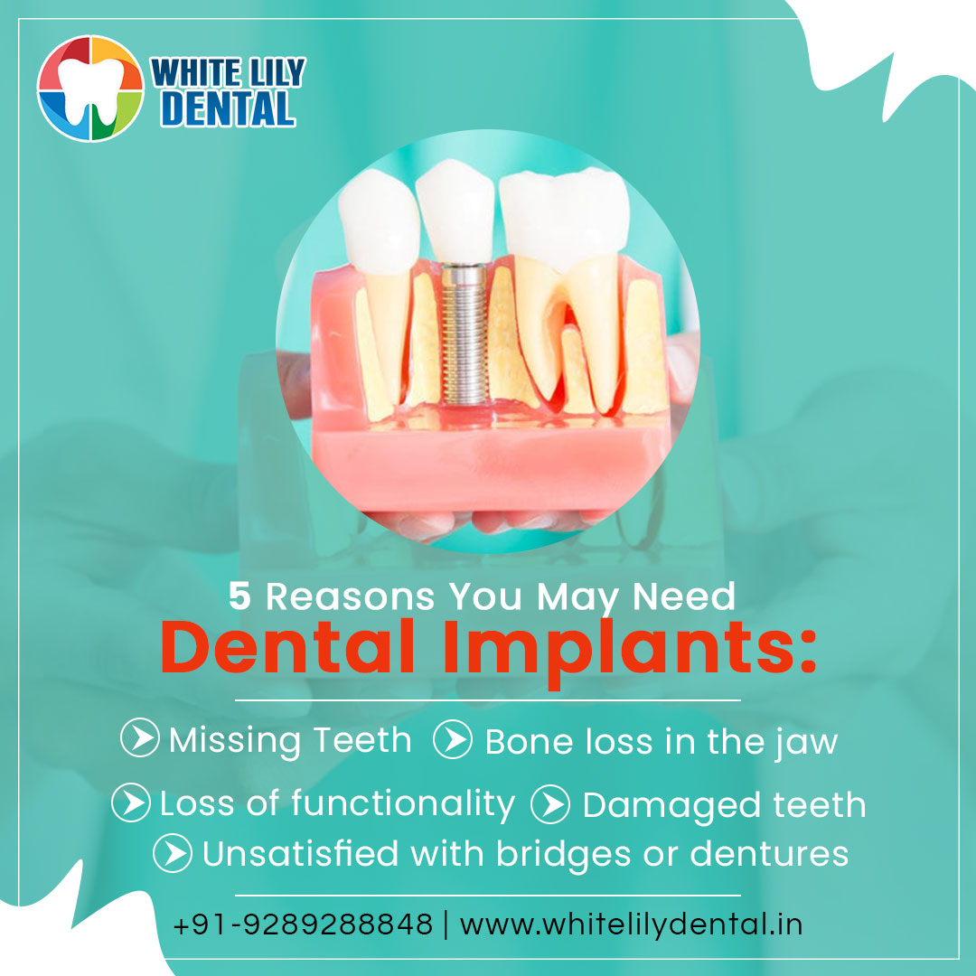 whitelilydental's tweet image. Symptoms Of Dental Implants!
Book an Appointment Today! Call us 📞 +91-9289288848. Visit: whitelilydental.in

#dentaltip #teethtip #goodhabits #kids #brushing #smilemakeover #oralhealth #dentistry #tooth #smile #dentist #dentalclinic #bestclinic #whitelilydental