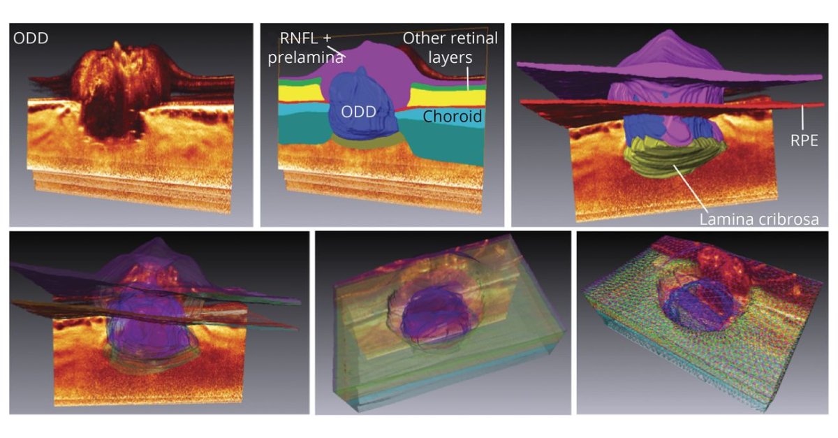 Discriminating Between Papilledema and Optic Disc Drusen Using 3D Structural Analysis of the Optic Nerve Head: bit.ly/3X8Qj3D

#Neuro #Ophthalmology #NeuroTwitter