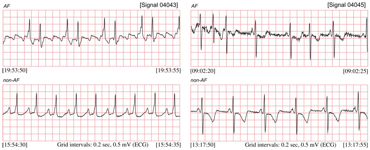 Sensors_MDPI's tweet photo. #highlycitedpaper
Detection of Atrial Fibrillation Episodes in Long-Term Heart Rhythm Signals Using a Support Vector Machine 
https://t.co/fUJwSUs4S9
#supportvectormachine #SVM #heartratevariability #HRV #atrialfibrillation #AFdetection https://t.co/O1xaoMG3Lx