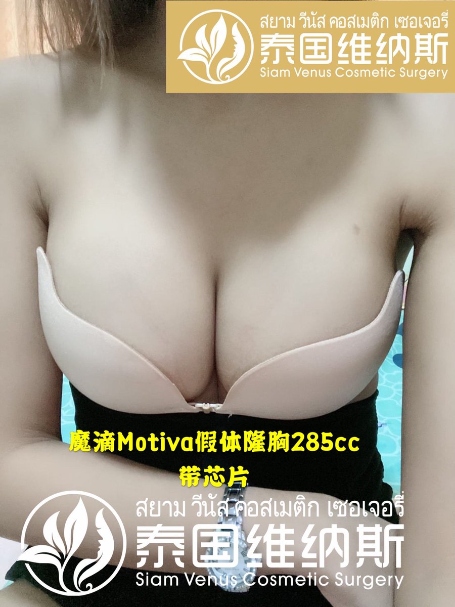 jsc749's tweet photo. 隆胸还是要医生技术好才行。
＃泰国隆胸
＃泰国整形
＃泰国医美
＃泰国隆鼻
＃泰国微整
＃威塑抽脂
＃泰国隆臀 https://t.co/6ZOqaujQkZ