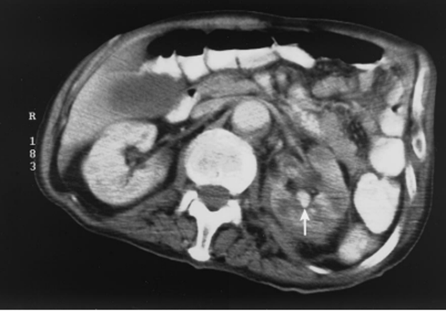 An nursing home 81-YO♂️, indwelling Foley catheter, recurrent urinary tract infection & urolithiasis: pus-like urine output, suprapubic pain, & burning pain with urination 
Urinalysis: leukocyte “packed” & “too numerous to count” 
CT.?
1/5

#radiology #nephrology #IDtwitter