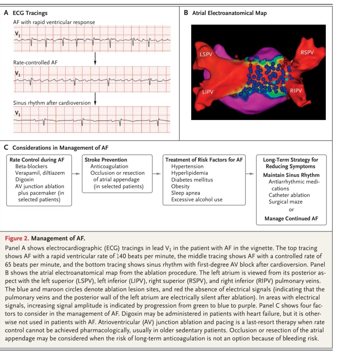 javier20ch's tweet photo. Fibrilación auricular🫀💥
✨️Revisión práctica por @NEJM 💯
▪️>2/3 de los 👥️ con FA de novo tienen patrón paroxístico, del 5-10%/año tienen progresión a persistente✍️
▪️Dx: taquiarritmia irregular (R-R variable).
▪️Tto: control FC/ritmo, anticoagulación
https://t.co/V0VStOHlOM https://t.co/iKXDM6yEU1