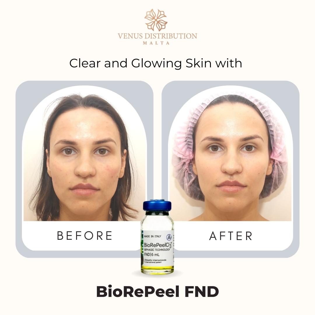 Italian two-phase peeling #BioRePeelCl3 simultaneously renews and moisturizes the skin.
Exclusively distributed by #venusdistributionmalta

#BioRePeelCl3 #BioRePeelCl3FND #Msida #Mosta #Naxxar #valletta #floriana #venusmalta #biostimulating #biorepeel #dermatologymalta