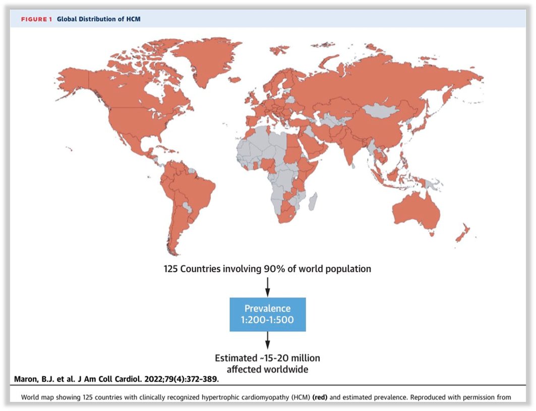 4) #HypertrophicCardiomyopathy (#HCM) is one of the most frequent inherited cardiovascular diseases (Prevalence between 1:200 & 1:500 globally). #HCM inheritance is autosomal dominant, its distribution of HCM is equal by sex, although women and black American are underdiagnosed.