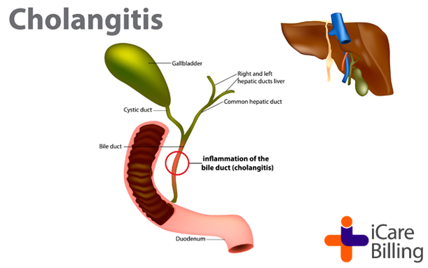 icarebilling's tweet image. Cholangitis is inflammation of bile duct system.The bile duct system carries bile from the liver and gallbladder to the first part of your small intestine. In most cases cholangitis is caused by a bacterial infection.
Follow #icarebilling for more updates
#HealthCare #Cholangitis