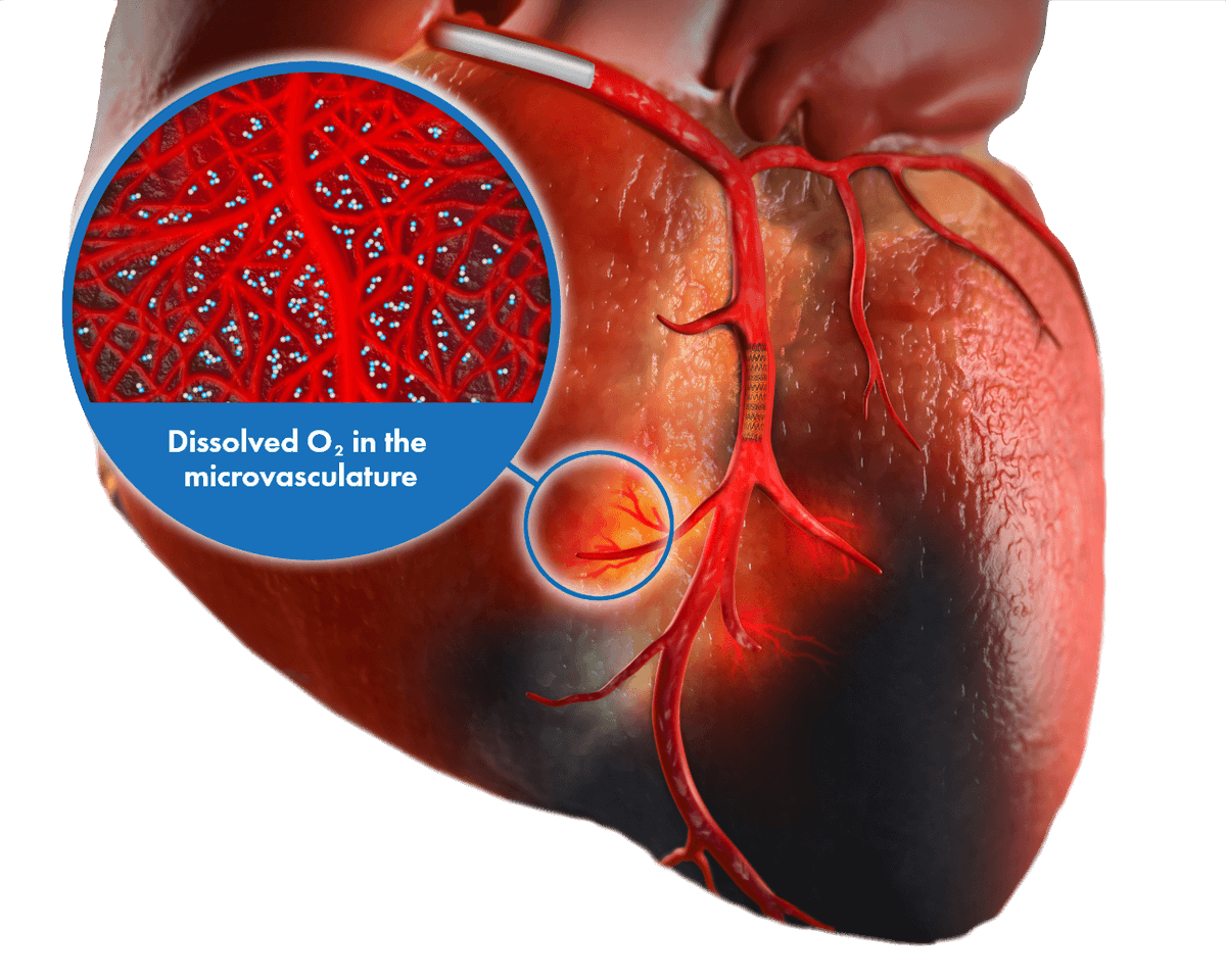 ZOLLTherOx's tweet photo. First Patient Enrolled in REAL SSO2 Study to Evaluate Clinical Utility and Economic Value of #ZOLL #TherOx #SSO2 Therapy - read more here: https://t.co/O0QfPJykRJ https://t.co/hrBQu7viS7