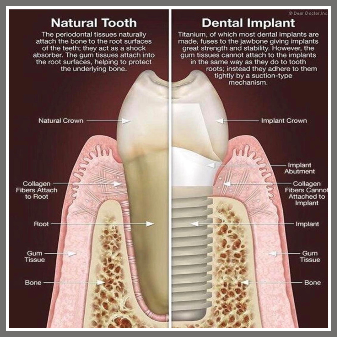 DrSarahMorris's tweet photo. Natural Tooth VS Dental Implant https://t.co/JAxGxMBIUv