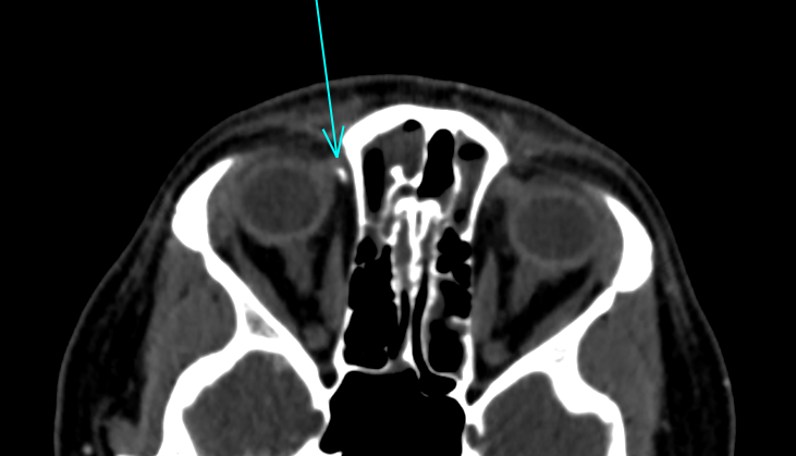 HeadNeckRads's tweet photo. These are trochlear calcifications.

I often see these misinterpreted (eg, fracture or foreign body). They are an incidental finding of no clinical consequence. I would not even report it. https://t.co/Keom9ZYj23
