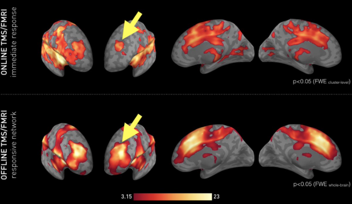 Out now in <a href="/NeuroImage_EiC/">NeuroImage</a> 
<a href="/MartinTik1/">Martin Tik</a> <a href="/MichaelWoletz/">Michael Woletz</a> <a href="/AnnaLisaSchule1/">Anna-Lisa Schuler</a> <a href="/MarVasileiadi/">Maria Vasileiadi</a> <a href="/cashmachine15/">Robin Cash</a> <a href="/AndrewZalesky/">Andrew Zalesky</a> <a href="/ClausLamm/">Claus Lamm</a> <a href="/cwindfMRI/">Christian Windischberger</a> 
 doi.org/10.1016/j.neur…

Using Interleaved TMS-fMRI we show activation increase at the stimulation site (DLPFC) and beyond👇