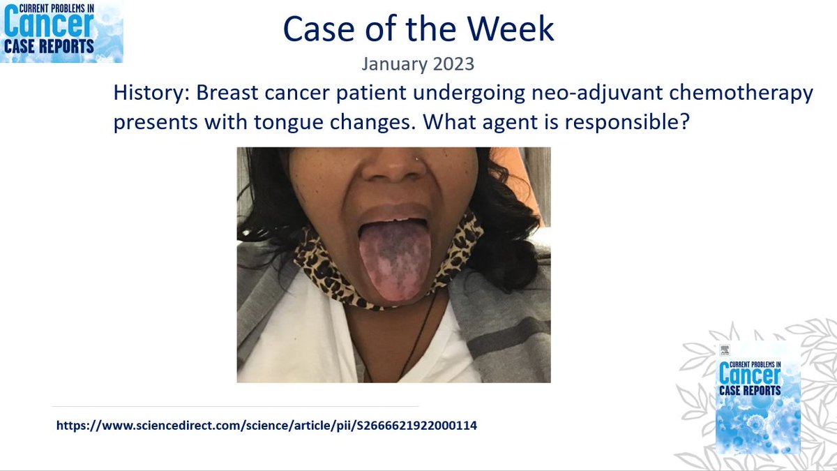 Test your knowledge with our Case of the Week! History: Breast cancer patient undergoing neo-adjuvant chemotherapy presents with tongue changes. #MedTwitter #CPCcasereports @OncologyAdvance @UPMCHillmanCC @breastoncdoc