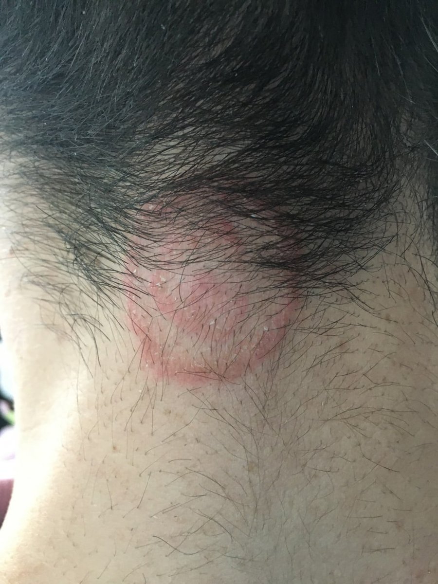 Academia Española de Dermatología y Venereología tweet media