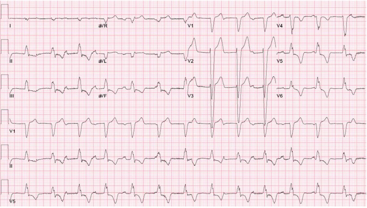 Check out our ECG challenge published today in @CircAHA! 'AV Block or Something Else?' Learned a lot about slow wide complex rhythms from brilliant EP docs Adam Oesterle and Nora Goldschlager @UCSFCardiology #EPeeps ahajournals.org/doi/10.1161/CI…