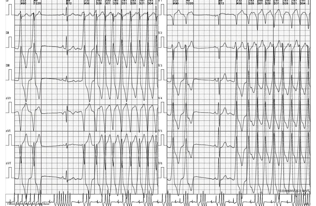 ComiteIcr's tweet photo. 📌New Electrocardiographic Challenge: 63 yo patient, infiltrative cardiomyopathy under study and incessant arrhythmia. Options on next twitt @mlanzotti2 @DiangeloSilvano @dchilabert @CamilaAntoniett https://t.co/H4dwIWoE1J