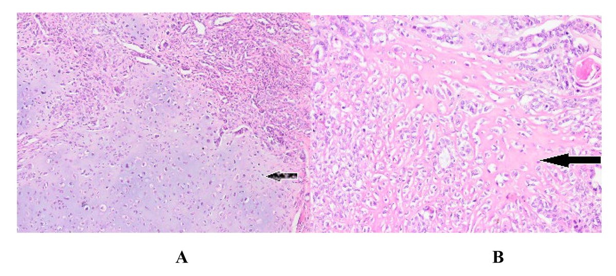 gan_aries's tweet photo. @CEOGjournal @ImrPress 
Welcome to read the publication about "#Uterine_cervical_carcinosarcoma".

Keywords:
#Carcinosarcoma   #Uterine_cervix  #Paramesonephric  #Mesonephric    #Hypercalcemia

You can read the full text at:
https://t.co/fZhmBmDD02 https://t.co/47lTilsEs0