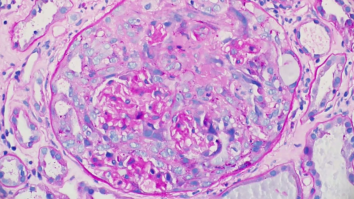MCW_Nephrology's tweet image. Excellent #Nephropath case discussion of an overlap syndrome (anti-GBM and ANCA) by @glom_busterMD and first year #Nephrology fellow Dr. Batool.