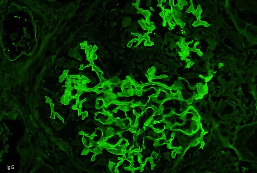MCW_Nephrology's tweet image. Excellent #Nephropath case discussion of an overlap syndrome (anti-GBM and ANCA) by @glom_busterMD and first year #Nephrology fellow Dr. Batool.