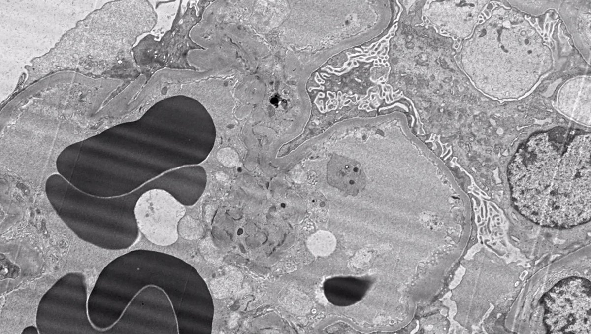 MCW_Nephrology's tweet image. Excellent #Nephropath case discussion of an overlap syndrome (anti-GBM and ANCA) by @glom_busterMD and first year #Nephrology fellow Dr. Batool.
