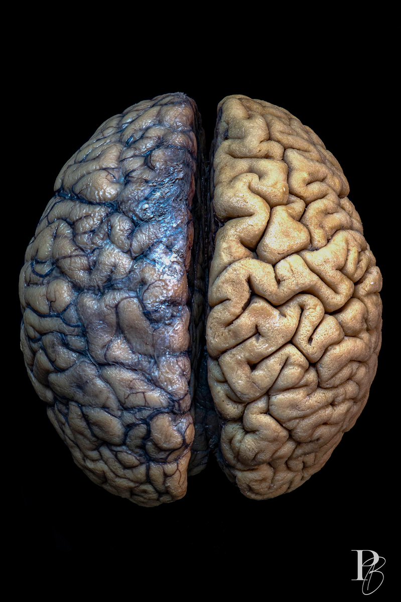How many gyri and sulci can you identify? #neuroquiz #neuroanatomy #neuro #brain #neurosurgery #medicine #photo