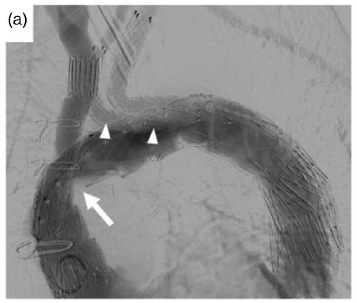 New solutions to old problems after Type A dissection… retrograde LCCA branch for an anastomotic pseudoaneurysm & kinked ascending graft doi.org/10.1177/170853… Thanks @VascularChch @cookvascular @CookMedical & @obexmedical @ericlim252 @R_A_Benson #vascular #thinkaorta #aortaEd
