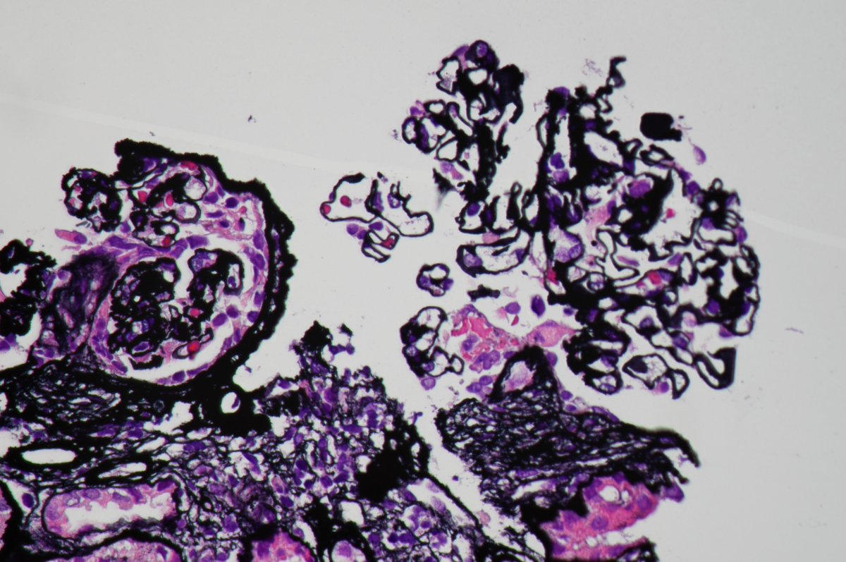 roboonya's tweet photo. Anti-GBM glomerulonephritis in a 60 yo F. Cellular crescent and small fibrinoid necrosis noted in LM. IgG linear staining along GBM by IF. #renalpath #pathtwitter https://t.co/wqT12zGxKR