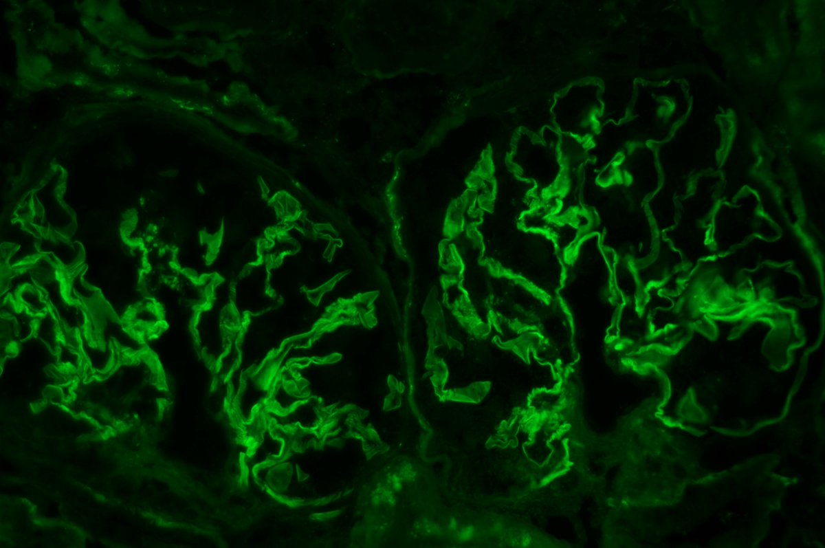 roboonya's tweet photo. Anti-GBM glomerulonephritis in a 60 yo F. Cellular crescent and small fibrinoid necrosis noted in LM. IgG linear staining along GBM by IF. #renalpath #pathtwitter https://t.co/wqT12zGxKR
