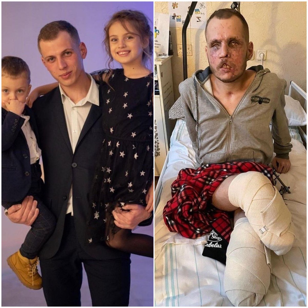 This is Serhiy Raylyan, the mortar commander of the 79th brigade. He has been defending Ukraine and was injured in November. He was in a 2-week coma, lost both legs, had a hip fracture, lost his eye and had multiple shrapnel wounds to his face. He has a beautiful family.