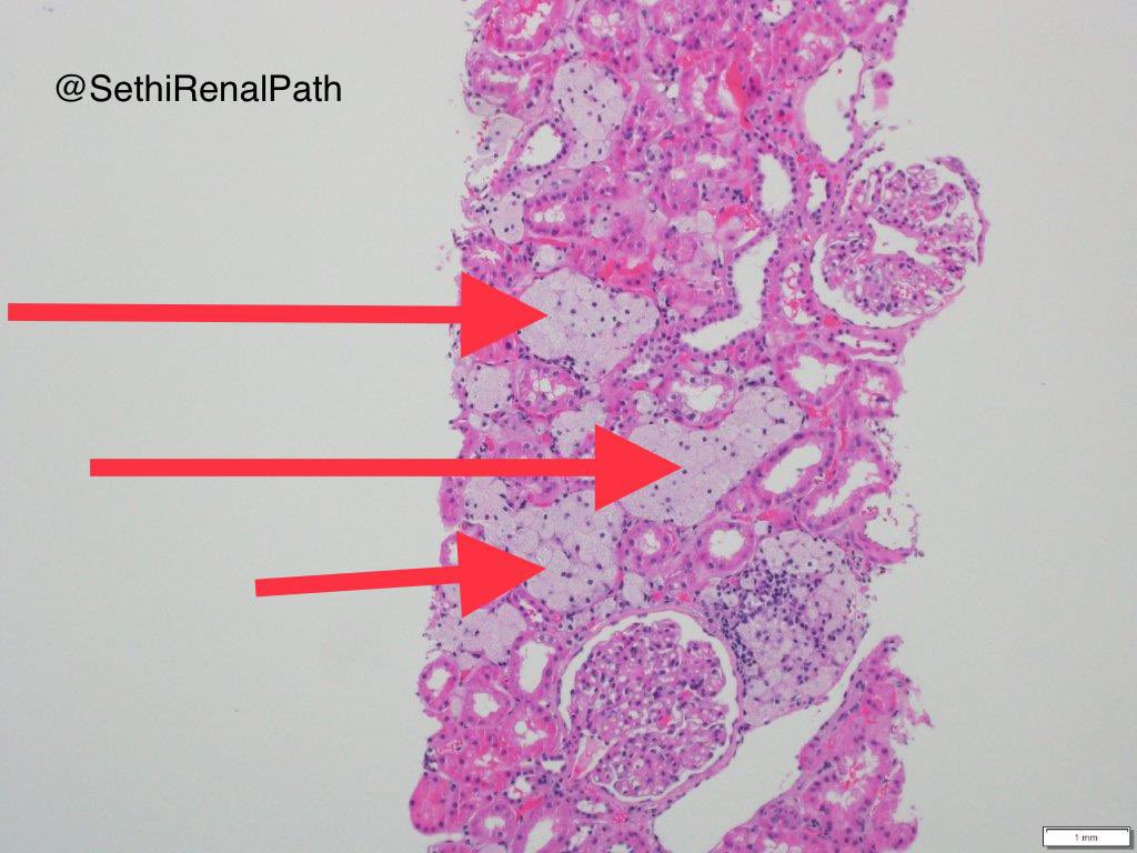 S.E.N. Nefrología on Twitter "RT SethiRenalPath Recent case Foam