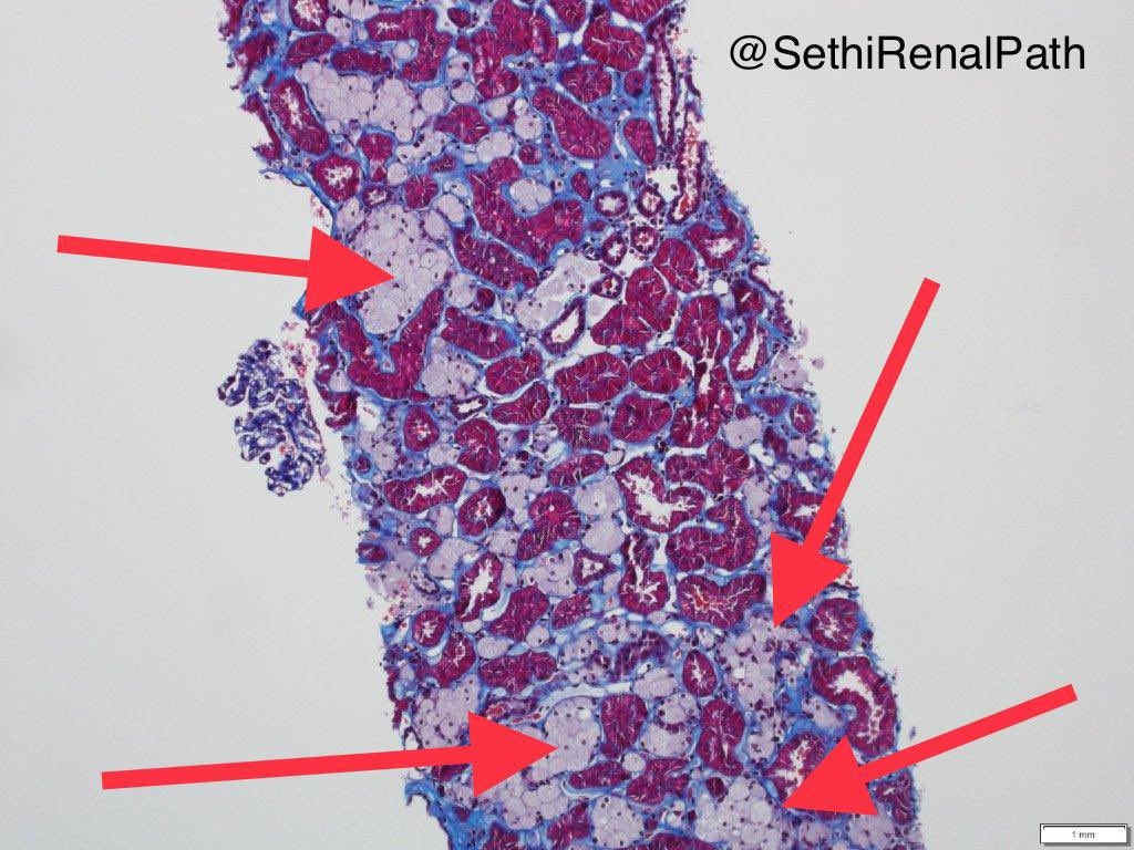 S.E.N. Nefrología on Twitter "RT SethiRenalPath Recent case Foam